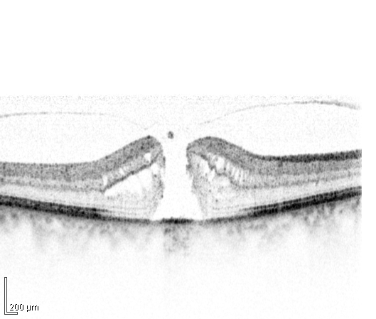macular hole